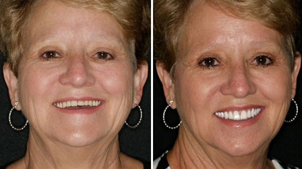 Before and After Fountain of Youth Dentures™