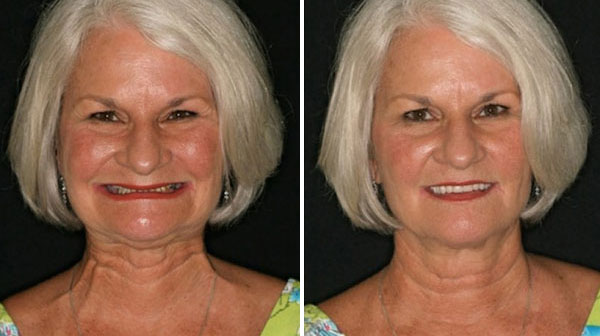 Before and After 2 Fountain of Youth Dentures™