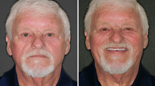 Before and After 3 Fountain of Youth Dentures™